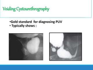 VoidingCystourethrography
•Gold standard for diagnosing PUV
• Typically shows :
 