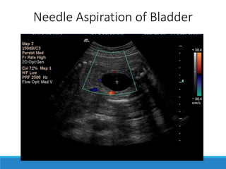 Needle Aspiration of Bladder
 