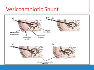 Vesicoamniotic Shunt
 