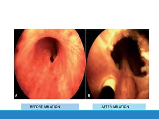 BEFORE ABLATION AFTER ABLATION
 