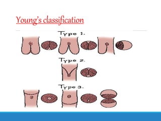 Young’s classification
 
