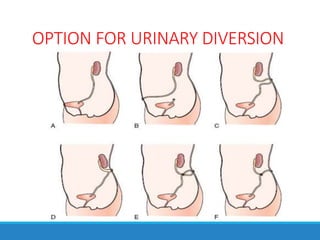 OPTION FOR URINARY DIVERSION
 