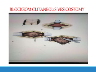 BLOCKSOMCUTANEOUS VESICOSTOMY
 