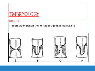 EMBRYOLOGY
TYPE-3 :(5%)
Incomplete dissolution of the urogenital membrane
 