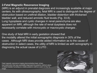2-Fetal Magnetic Resonance Imaging
(MRI) is an adjunct in prenatal diagnosis and increasingly available at major
centers. As with ultrasonography, fetal MRI is used to distinguish the degree of
obstruction based on urethral dilation, bladder distention with thickened
bladder wall, and reduced amniotic fluid levels (Fig. 33.8).
Lung hypoplasia and cystic changes in renal parenchyma are also
apparent on MRI, although the rate of renal dysplasia does not
necessarily correlate with microcystic or macrocystic changes .
One study of fetal MRI in early gestation showed that
the modality altered the initial sonographic diagnosis in 30% of the
cases . Although MRI does provide added information as to the cause of
obstruction in select cases, the utility of MRI is limited as with sonography in
diagnosing the actual cause of LUTO .
Fetal magnetic resonance imaging demonstrating lower urinary
tract obstruction that was postnatally diagnosed as posterior urethral valves.
A dilated bladder funneling to a visible posterior urethra is seen on this T2
image .
 