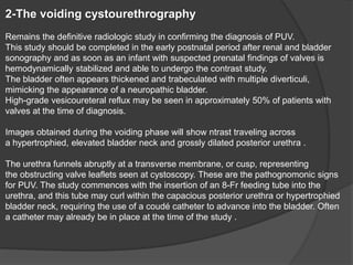 2-The voiding cystourethrography
Remains the definitive radiologic study in confirming the diagnosis of PUV.
This study should be completed in the early postnatal period after renal and bladder
sonography and as soon as an infant with suspected prenatal findings of valves is
hemodynamically stabilized and able to undergo the contrast study.
The bladder often appears thickened and trabeculated with multiple diverticuli,
mimicking the appearance of a neuropathic bladder.
High-grade vesicoureteral reflux may be seen in approximately 50% of patients with
valves at the time of diagnosis.
Images obtained during the voiding phase will show ntrast traveling across
a hypertrophied, elevated bladder neck and grossly dilated posterior urethra .
The urethra funnels abruptly at a transverse membrane, or cusp, representing
the obstructing valve leaflets seen at cystoscopy. These are the pathognomonic signs
for PUV. The study commences with the insertion of an 8-Fr feeding tube into the
urethra, and this tube may curl within the capacious posterior urethra or hypertrophied
bladder neck, requiring the use of a coudé catheter to advance into the bladder. Often
a catheter may already be in place at the time of the study .
 