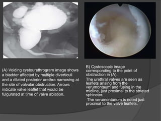 (A) Voiding cystourethrogram image shows
a bladder affected by multiple diverticuli
and a dilated posterior urethra narrowing at
the site of valvular obstruction. Arrows
indicate valve leaflet that would be
fulgurated at time of valve ablation.
B) Cystoscopic image
corresponding to the point of
obstruction in (A).
The urethral valves are seen as
leaflets arising from the
verumontaum and fusing in the
midline, just proximal to the striated
sphincter.
The verumontanum is noted just
proximal to the valve leaflets.
 