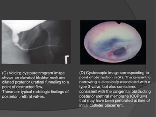 (C) Voiding cystourethrogram image
shows an elevated bladder neck and
dilated posterior urethral funneling to a
point of obstructed flow.
These are typical radiologic findings of
posterior urethral valves.
(D) Cystoscopic image corresponding to
point of obstruction in (A). The concentric
narrowing is classically associated with a
type 3 valve, but also considered
consistent with the congenital obstructing
posterior urethral membrane (COPUM)
that may have been perforated at time of
initial catheter placement.
 