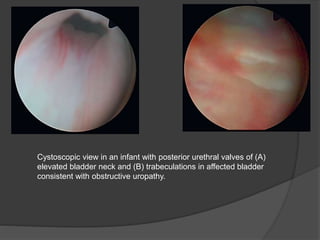 Cystoscopic view in an infant with posterior urethral valves of (A)
elevated bladder neck and (B) trabeculations in affected bladder
consistent with obstructive uropathy.
 