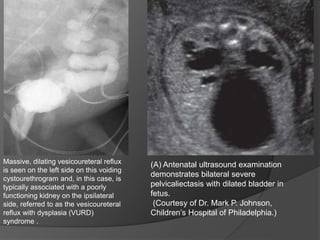 Massive, dilating vesicoureteral reflux
is seen on the left side on this voiding
cystourethrogram and, in this case, is
typically associated with a poorly
functioning kidney on the ipsilateral
side, referred to as the vesicoureteral
reflux with dysplasia (VURD)
syndrome .
(A) Antenatal ultrasound examination
demonstrates bilateral severe
pelvicaliectasis with dilated bladder in
fetus.
(Courtesy of Dr. Mark P. Johnson,
Children’s Hospital of Philadelphia.)
 