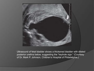 Ultrasound of fetal bladder shows a thickened bladder with dilated
posterior urethra below, suggesting the “keyhole sign.” (Courtesy
of Dr. Mark P. Johnson, Children’s Hospital of Philadelphia.)
 
