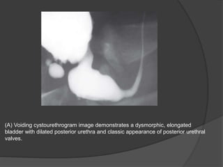 (A) Voiding cystourethrogram image demonstrates a dysmorphic, elongated
bladder with dilated posterior urethra and classic appearance of posterior urethral
valves.
 