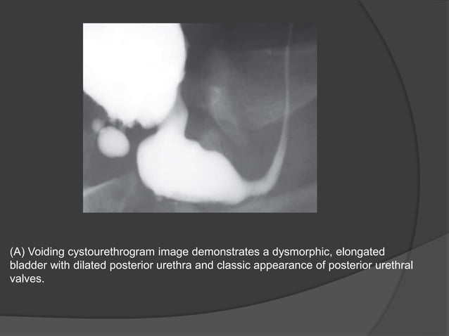 Posterior urethral valve | PPTX
