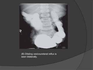 (B) Dilating vesicoureteral reflux is
seen bilaterally.
 