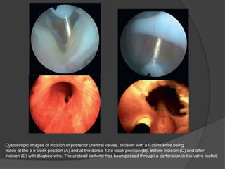 Cystoscopic images of incision of posterior urethral valves. Incision with a Collins knife being
made at the 5 o’clock position (A) and at the dorsal 12 o’clock position (B). Before incision (C) and after
incision (D) with Bugbee wire. The ureteral catheter has been passed through a perforation in the valve leaflet.
 