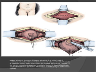 Blocksom technique for performance of cutaneous vesicostomy. (A) An incision is made at
a point midway between the umbilicus and pubis that corresponds to the upper limit of the filled bladder.
(B) A transverse incision is made in the rectus fascia, and the bladder detrusor muscle is exposed. (C)
Stay sutures or noncrushing clamps are used to mobilize the bladder while dissecting the peritoneum
away from the bladder dome. (D) The dome of the bladder is identified by ligating the urachal remnant.
Continued
 