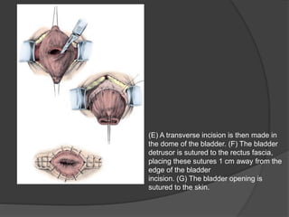 (E) A transverse incision is then made in
the dome of the bladder. (F) The bladder
detrusor is sutured to the rectus fascia,
placing these sutures 1 cm away from the
edge of the bladder
incision. (G) The bladder opening is
sutured to the skin.
 