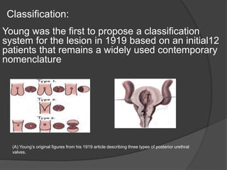 Young was the first to propose a classification
system for the lesion in 1919 based on an initial12
patients that remains a widely used contemporary
nomenclature
Classification:
(A) Young’s original figures from his 1919 article describing three types of posterior urethral
valves.
 