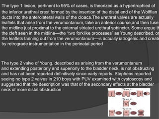 The type 1 lesion, pertinent to 95% of cases, is theorized as a hypertrophied of
the inferior urethral crest formed by the insertion of the distal end of the Wolffian
ducts into the anterolateral walls of the cloaca.The urethral valves are actually
leaflets that arise from the verumontanum, take an anterior course,and then fuse
the midline just proximal to the external striated urethral sphincter. Some argue th
the cleft seen in the midline—the “two forklike processes” as Young described, or
the leaflets fanning out from the verumontanum—is actually iatrogenic and create
by retrograde instrumentation in the perinatal period
The type 2 valve of Young, described as arising from the verumontanum
and extending posteriorly and superiorly to the bladder neck, is not obstructing
and has not been reported definitively since early reports. Stephens reported
seeing no type 2 valves in 210 boys with PUV examined with cystoscopy and
suggested that the description was that of the secondary effects at the bladder
neck of more distal obstruction
 