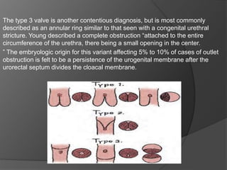 The type 3 valve is another contentious diagnosis, but is most commonly
described as an annular ring similar to that seen with a congenital urethral
stricture. Young described a complete obstruction “attached to the entire
circumference of the urethra, there being a small opening in the center.
” The embryologic origin for this variant affecting 5% to 10% of cases of outlet
obstruction is felt to be a persistence of the urogenital membrane after the
urorectal septum divides the cloacal membrane.
 