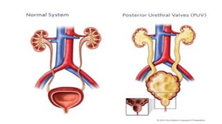 Puv Size puv last draft: Posterior Urethral Valve (PUV) – Overview 1. | PPTX