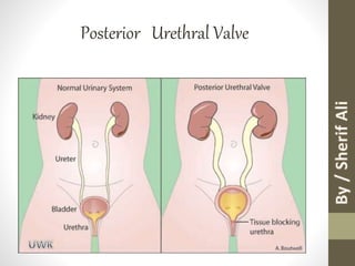 Posterior Urethral Valve
 