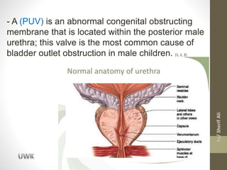Puv Size PUV presentation urology in sohag university.pptx