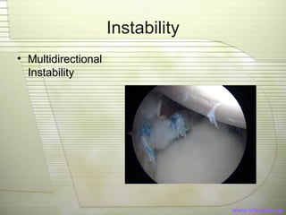 Multidimensional Instability Shoulder and elbow | PPT
