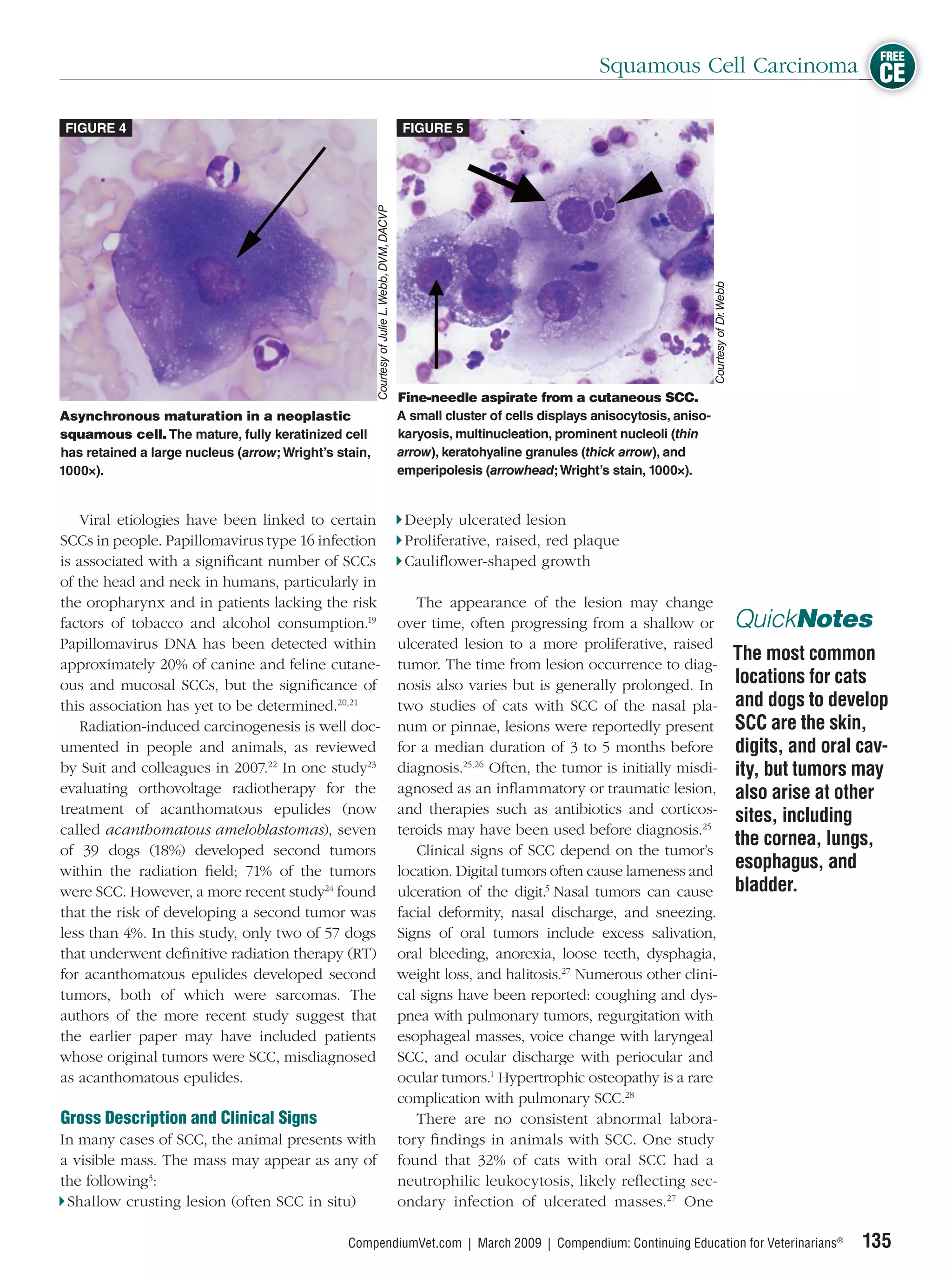 FREE
                                                                                                                                 Squamous Cell Carcinoma CE

 FIGURE 4                                                                                      FIGURE 5




                                                       Courtesy of Julie L. Webb, DVM, DACVP




                                                                                                                                                        Courtesy of Dr. Webb
                                                                                               Fine-needle aspirate from a cutaneous SCC.
Asynchronous maturation in a neoplastic                                                        A small cluster of cells displays anisocytosis, aniso-
squamous cell. The mature, fully keratinized cell                                              karyosis, multinucleation, prominent nucleoli (thin
has retained a large nucleus (arrow; Wright’s stain,                                           arrow), keratohyaline granules (thick arrow), and
1000×).                                                                                        emperipolesis (arrowhead; Wright’s stain, 1000×).


    Viral etiologies have been linked to certain                                                Deeply ulcerated lesion
SCCs in people. Papillomavirus type 16 infection                                                Proliferative, raised, red plaque
is associated with a signiﬁcant number of SCCs                                                  Cauliﬂower-shaped growth
of the head and neck in humans, particularly in
the oropharynx and in patients lacking the risk                                                   The appearance of the lesion may change
factors of tobacco and alcohol consumption.19                                                  over time, often progressing from a shallow or                                  QuickNotes
Papillomavirus DNA has been detected within                                                    ulcerated lesion to a more proliferative, raised
approximately 20% of canine and feline cutane-                                                 tumor. The time from lesion occurrence to diag-
                                                                                                                                                                               The most common
ous and mucosal SCCs, but the signiﬁcance of                                                   nosis also varies but is generally prolonged. In                                locations for cats
this association has yet to be determined.20,21                                                two studies of cats with SCC of the nasal pla-                                  and dogs to develop
    Radiation-induced carcinogenesis is well doc-                                              num or pinnae, lesions were reportedly present                                  SCC are the skin,
umented in people and animals, as reviewed                                                     for a median duration of 3 to 5 months before                                   digits, and oral cav-
by Suit and colleagues in 2007.22 In one study23                                               diagnosis.25,26 Often, the tumor is initially misdi-                            ity, but tumors may
evaluating orthovoltage radiotherapy for the                                                   agnosed as an inﬂammatory or traumatic lesion,                                  also arise at other
treatment of acanthomatous epulides (now                                                       and therapies such as antibiotics and corticos-
                                                                                                                                                                               sites, including
called acanthomatous ameloblastomas), seven                                                    teroids may have been used before diagnosis.25
                                                                                                                                                                               the cornea, lungs,
of 39 dogs (18%) developed second tumors                                                          Clinical signs of SCC depend on the tumor’s
within the radiation ﬁeld; 71% of the tumors                                                   location. Digital tumors often cause lameness and                               esophagus, and
were SCC. However, a more recent study24 found                                                 ulceration of the digit.5 Nasal tumors can cause                                bladder.
that the risk of developing a second tumor was                                                 facial deformity, nasal discharge, and sneezing.
less than 4%. In this study, only two of 57 dogs                                               Signs of oral tumors include excess salivation,
that underwent deﬁnitive radiation therapy (RT)                                                oral bleeding, anorexia, loose teeth, dysphagia,
for acanthomatous epulides developed second                                                    weight loss, and halitosis.27 Numerous other clini-
tumors, both of which were sarcomas. The                                                       cal signs have been reported: coughing and dys-
authors of the more recent study suggest that                                                  pnea with pulmonary tumors, regurgitation with
the earlier paper may have included patients                                                   esophageal masses, voice change with laryngeal
whose original tumors were SCC, misdiagnosed                                                   SCC, and ocular discharge with periocular and
as acanthomatous epulides.                                                                     ocular tumors.1 Hypertrophic osteopathy is a rare
                                                                                               complication with pulmonary SCC.28
Gross Description and Clinical Signs                                                              There are no consistent abnormal labora-
In many cases of SCC, the animal presents with                                                 tory ﬁndings in animals with SCC. One study
a visible mass. The mass may appear as any of                                                  found that 32% of cats with oral SCC had a
the following3:                                                                                neutrophilic leukocytosis, likely reﬂecting sec-
 Shallow crusting lesion (often SCC in situ)                                                   ondary infection of ulcerated masses.27 One

                                                CompendiumVet.com | March 2009 | Compendium: Continuing Education for Veterinarians®                                                            135
 