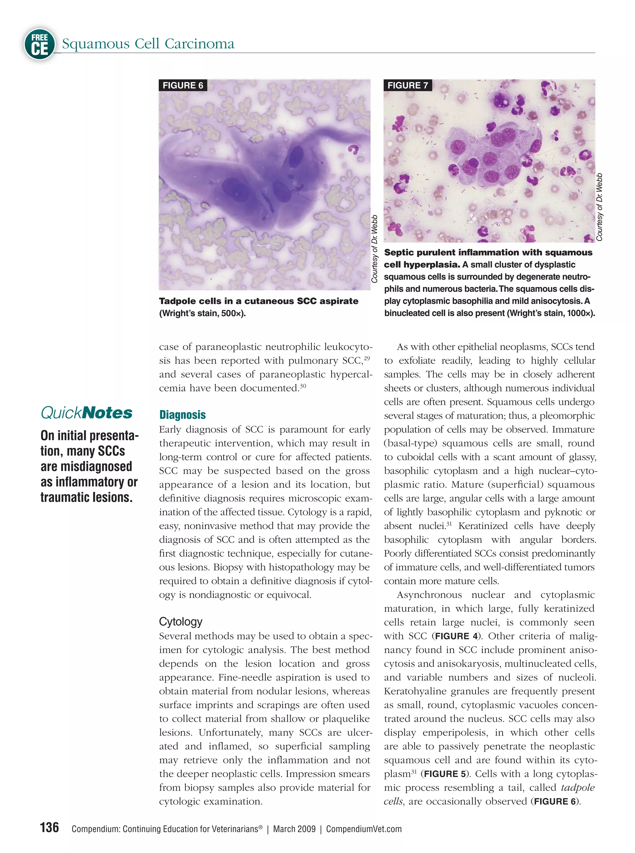 FREE
CE Squamous Cell Carcinoma
                              FIGURE 6                                                                    FIGURE 7




                                                                                                                                                                      Courtesy of Dr. Webb
                                                                                   Courtesy of Dr. Webb
                                                                                                          Septic purulent inﬂammation with squamous
                                                                                                          cell hyperplasia. A small cluster of dysplastic
                                                                                                          squamous cells is surrounded by degenerate neutro-
                                                                                                          phils and numerous bacteria. The squamous cells dis-
                             Tadpole cells in a cutaneous SCC aspirate                                    play cytoplasmic basophilia and mild anisocytosis. A
                             (Wright’s stain, 500×).                                                      binucleated cell is also present (Wright’s stain, 1000×).


                             case of paraneoplastic neutrophilic leukocyto-                                   As with other epithelial neoplasms, SCCs tend
                             sis has been reported with pulmonary SCC,29                                  to exfoliate readily, leading to highly cellular
                             and several cases of paraneoplastic hypercal-                                samples. The cells may be in closely adherent
                             cemia have been documented.30                                                sheets or clusters, although numerous individual
                                                                                                          cells are often present. Squamous cells undergo
 QuickNotes                  Diagnosis                                                                    several stages of maturation; thus, a pleomorphic
                             Early diagnosis of SCC is paramount for early                                population of cells may be observed. Immature
 On initial presenta-        therapeutic intervention, which may result in                                (basal-type) squamous cells are small, round
 tion, many SCCs             long-term control or cure for affected patients.                             to cuboidal cells with a scant amount of glassy,
 are misdiagnosed            SCC may be suspected based on the gross                                      basophilic cytoplasm and a high nuclear–cyto-
 as inﬂammatory or           appearance of a lesion and its location, but                                 plasmic ratio. Mature (superﬁcial) squamous
 traumatic lesions.          deﬁnitive diagnosis requires microscopic exam-                               cells are large, angular cells with a large amount
                             ination of the affected tissue. Cytology is a rapid,                         of lightly basophilic cytoplasm and pyknotic or
                             easy, noninvasive method that may provide the                                absent nuclei.31 Keratinized cells have deeply
                             diagnosis of SCC and is often attempted as the                               basophilic cytoplasm with angular borders.
                             ﬁrst diagnostic technique, especially for cutane-                            Poorly differentiated SCCs consist predominantly
                             ous lesions. Biopsy with histopathology may be                               of immature cells, and well-differentiated tumors
                             required to obtain a deﬁnitive diagnosis if cytol-                           contain more mature cells.
                             ogy is nondiagnostic or equivocal.                                               Asynchronous nuclear and cytoplasmic
                                                                                                          maturation, in which large, fully keratinized
                             Cytology                                                                     cells retain large nuclei, is commonly seen
                             Several methods may be used to obtain a spec-                                with SCC (FIGURE 4). Other criteria of malig-
                             imen for cytologic analysis. The best method                                 nancy found in SCC include prominent aniso-
                             depends on the lesion location and gross                                     cytosis and anisokaryosis, multinucleated cells,
                             appearance. Fine-needle aspiration is used to                                and variable numbers and sizes of nucleoli.
                             obtain material from nodular lesions, whereas                                Keratohyaline granules are frequently present
                             surface imprints and scrapings are often used                                as small, round, cytoplasmic vacuoles concen-
                             to collect material from shallow or plaquelike                               trated around the nucleus. SCC cells may also
                             lesions. Unfortunately, many SCCs are ulcer-                                 display emperipolesis, in which other cells
                             ated and inﬂamed, so superﬁcial sampling                                     are able to passively penetrate the neoplastic
                             may retrieve only the inﬂammation and not                                    squamous cell and are found within its cyto-
                             the deeper neoplastic cells. Impression smears                               plasm31 (FIGURE 5). Cells with a long cytoplas-
                             from biopsy samples also provide material for                                mic process resembling a tail, called tadpole
                             cytologic examination.                                                       cells, are occasionally observed (FIGURE 6).

 136   Compendium: Continuing Education for Veterinarians® | March 2009 | CompendiumVet.com
 