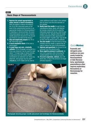 FREE
                                                                                                         Pneumothorax CE

BOX 2

 Basic Steps of Thoracocentesis

 1. Restrain the animal appropriately in               make additional small holes in the catheter
    either sternal or lateral recumbency.              that are about one-third the diameter of
    With the patient in lateral recumbency,            the catheter.
    the 7th to 9th intercostal space at the       5.   Gently insert the needle through the skin,
    level of the costochondral junction is an          subcutaneous tissue, fascia, and intercos-
    appropriate location for thoracocentesis.4         tal muscles cranial to the rib to avoid the
    In standing or sternal animals, the same           intercostal vessels and nerves, which lie just
    intercostal spaces can be used; however,           caudal to the ribs. Aspirate while the needle
    needle placement should be in the dorsal           is being advanced to allow appreciation of
    two-thirds to one-third of the thorax.4            the proper depth.4 A gentle “pop” may be felt
 2. Clip and aseptically prepare the 7th to            as entry into the pleural cavity is achieved.
    9th intercostal space.                        6.   Turn the needle so that the bevel is facing
 3. A local anesthetic block of the area is            medially and the needle is against the rib
    encouraged.4                                       cage to reduce the risk of lung laceration.         QuickNotes
 4. In small dogs and cats, a butterﬂy            7.   Aspirate and quantitate the amount of air
    catheter (19 to 23 gauge) connected to a           removed from the pleural cavity.                    Traumatic and
    three-way stopcock may be used for aspi-      8.   Once negative pressure is achieved, be              iatrogenic pneu-
    ration.44 In larger dogs or obese animals,         sure not to aspirate while removing the             mothorax are com-
    a large-bore over-the-needle catheter              needle/catheter from the pleural cavity.            monly treated by
    connected to an extension set, three-way      9.   If no air is aspirated, redirect, tap a dif-
                                                                                                           thoracocentesis
    stopcock, and syringe may be used44                ferent site, or stop if the animal is no longer
    (FIGURE A). A #11 blade can be used to             clinically dyspneic.44                              or tube thoracos-
                                                                                                           tomy; spontaneous
  FIGURE A                                                                                                 pneumothorax often
                                                                                                           requires exploratory
                                                                                                           thoracotomy or
                                                                                                           thoracoscopy for
                                                                                                           resection.




 Photograph showing proper needle placement and technique for thoracocentesis.



                                            CompendiumVet.com | May 2009 | Compendium: Continuing Education for Veterinarians®   237
 