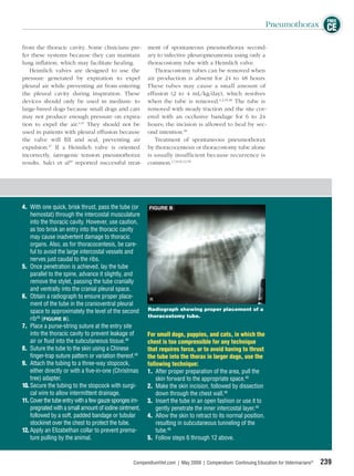 FREE
                                                                                                               Pneumothorax CE

from the thoracic cavity. Some clinicians pre-          ment of spontaneous pneumothorax second-
fer these systems because they can maintain             ary to infective pleuropneumonia using only a
lung inﬂation, which may facilitate healing.            thoracostomy tube with a Heimlich valve.
   Heimlich valves are designed to use the                 Thoracostomy tubes can be removed when
pressure generated by expiration to expel               air production is absent for 24 to 48 hours.
pleural air while preventing air from entering          These tubes may cause a small amount of
the pleural cavity during inspiration. These            effusion (2 to 4 mL/kg/day), which resolves
devices should only be used in medium- to               when the tube is removed.4,2,45,48 The tube is
large-breed dogs because small dogs and cats            removed with steady traction and the site cov-
may not produce enough pressure on expira-              ered with an occlusive bandage for 6 to 24
tion to expel the air.4,47 They should not be           hours; the incision is allowed to heal by sec-
used in patients with pleural effusion because          ond intention.48
the valve will ﬁll and seal, preventing air                Treatment of spontaneous pneumothorax
expulsion.47 If a Heimlich valve is oriented            by thoracocentesis or thoracostomy tube alone
incorrectly, iatrogenic tension pneumothorax            is usually insufficient because recurrence is
results. Salci et al49 reported successful treat-       common.1,7,8,10,12,50




4. With one quick, brisk thrust, pass the tube (or       FIGURE B
    hemostat) through the intercostal musculature
    into the thoracic cavity. However, use caution,
    as too brisk an entry into the thoracic cavity
    may cause inadvertent damage to thoracic
    organs. Also, as for thoracocentesis, be care-
    ful to avoid the large intercostal vessels and
    nerves just caudal to the ribs.
5. Once penetration is achieved, lay the tube
    parallel to the spine, advance it slightly, and
    remove the stylet, passing the tube cranially
    and ventrally into the cranial pleural space.
6. Obtain a radiograph to ensure proper place-
    ment of the tube in the cranioventral pleural
    space to approximately the level of the second      Radiograph showing proper placement of a
                                                        thoracostomy tube.
    rib48 (FIGURE B).
7. Place a purse-string suture at the entry site
    into the thoracic cavity to prevent leakage of      For small dogs, puppies, and cats, in which the
    air or ﬂuid into the subcutaneous tissue.48         chest is too compressible for any technique
8. Suture the tube to the skin using a Chinese          that requires force, or to avoid having to thrust
    ﬁnger-trap suture pattern or variation thereof.48   the tube into the thorax in larger dogs, use the
9. Attach the tubing to a three-way stopcock,           following technique:
    either directly or with a ﬁve-in-one (Christmas     1. After proper preparation of the area, pull the
    tree) adapter.                                          skin forward to the appropriate space.48
10. Secure the tubing to the stopcock with surgi-       2. Make the skin incision, followed by dissection
    cal wire to allow intermittent drainage.                down through the chest wall.48
11. Cover the tube entry with a few gauze sponges im-   3. Insert the tube in an open fashion or use it to
    pregnated with a small amount of iodine ointment,       gently penetrate the inner intercostal layer.48
    followed by a soft, padded bandage or tubular       4. Allow the skin to retract to its normal position,
    stockinet over the chest to protect the tube.           resulting in subcutaneous tunneling of the
12. Apply an Elizabethan collar to prevent prema-           tube.48
    ture pulling by the animal.                         5. Follow steps 6 through 12 above.


                                                  CompendiumVet.com | May 2009 | Compendium: Continuing Education for Veterinarians®   239
 