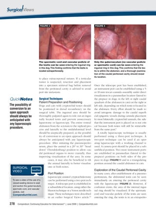 FIGURE 3                                                 FIGURE 4




                             The spermatic cord and vascular pedicle of               Only the gubernaculum (no vascular pedicle
                             the testis can be seen entering the inguinal ring        or spermatic cord) can be seen entering the
                             in this dog. This finding confirms that the testis is    inguinal ring in this dog. This confirms that the tes-
                             located extraperitoneally.                               tis is within the abdomen, and a thorough examina-
                                                                                      tion of the caudal peritoneal cavity should reveal
                                                                                      its location.
                             to place extracorporeal sutures. If a testicular
                             tumor is suspected, resection and placement
                             into a specimen retrieval bag before removal             Once the telescope port has been established,
                             from the peritoneal cavity is advised to avoid           an instrument port can be established using a 5-
                             port site metastasis.                                    or 10-mm trocar–cannula assembly under direct
                                                                                      visualization in a paramedian location (lateral to
QuickNotes                   Surgical Techniques                                      the prepuce in dogs; in the left or right caudal
                             Patient Preparation and Positioning                      quadrant of the abdomen in cats) on the right or
The possibility of           Dogs and cats with cryptorchid testes should             left side, depending on which testis is located in
conversion to an             be positioned in dorsal recumbency on the                the abdomen. Every effort should be made to
open approach                surgical table. The inguinal area should be              avoid iatrogenic damage to the caudal superﬁ-
should always be             thoroughly palpated again to rule out an ingui-          cial epigastric vessels during cannula placement.
anticipated with             nally located testis and prevent unnecessary             In most bilaterally cryptorchid animals, the side
                             laparotomy or laparoscopy. The entire ventral            that the instrument port is placed on is not criti-
any laparoscopic
                             abdomen from the scrotum to the xiphoid pro-             cal because both testes will still be retrievable
procedure.                   cess and laterally to the midabdominal level             from the same port.9
                             should be aseptically prepared, as the possibil-             A totally laparoscopic technique is usually
                             ity of conversion to an open approach should             performed using a three-port technique. A
                             always be anticipated with any laparoscopic              two-port technique can be used if an oper-
                             procedure. After initiating the pneumoperito-            ating laparoscope with a working channel is
                             neum, place the animal in a 20° to 30° “head             used. A camera port should be placed in a sub-
                             down” (Trendelenburg) position to allow cau-             umbilical position. Two more instrument ports
                             dal peritoneal organs to move cranially, thus            are established in paramedian (lateral to the
                             improving visualization of the area. In some             prepuce) positions on both sides of the pre-
                                      cases, it may also be beneﬁcial to tilt         puce in dogs (FIGURE 1) and in a triangulating
                                      the animal laterally to better visualize        position around the caudal abdomen in cats.
  SURGICAL                            one or both testes.
  VIDEO                                                                               Exploration of the Caudal Peritoneal Cavity
                                      Port Position                                   In many cases, after establishment of a pneumo-
                                      Laparoscopic-assisted cryptorchidectomy         peritoneum, the abdominal testis can be seen
  To see a video of the use of a      can be performed using a two-port tech-         immediately on entering the peritoneal cavity
  vessel-sealing device to seal       nique. A telescope port is established in       with the laparoscope (FIGURE 2). However, if
  and section the gubernaculum,
                                      a subumbilical location, using either the       confusion exists, the area of the internal ingui-
  spermatic cord, and vascular
                                      Hasson technique or a Veress needle tech-       nal ring should be visualized. If the spermatic
  pedicle, visit
  CompendiumVet.com.                  nique. These techniques were described          cord and vascular pedicle of the testis are seen
                                      in an earlier Surgical Views article.10         entering the ring, the testis is in an extraperito-

278    Compendium: Continuing Education for Veterinarians® | June 2009 | CompendiumVet.com
 