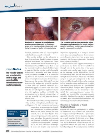 FIGURE 5                                                 FIGURE 6




                             The testis is elevated for totally laparo-               The vascular pedicle after sectioning using
                             scopic cryptorchidectomy to allow better                 the vessel-sealing device. The pedicle has been
                             access to the vascular pedicle and spermatic cord        sealed in two different locations approximately 1 cm
                             during intracorporeal ligation of these structures.      apart to ensure good hemostasis.


                            naculum, spermatic cord, and vascular pedicle             disposable equipment), it is likely to be the
                            sealed and subsequently sectioned.                        most time-consuming because these sutures
                                The vascular pedicle can be substantial in            are tedious to place; however, a rapid learn-
                            large dogs, and care should be taken to ensure            ing curve has been seen in studies that used
                            adequate hemostasis. The Ligasure and Enseal              extracorporeal suturing.12
                            devices are both indicated to seal vessels up to             When laparoscopic cryptorchidectomy is
                            7 mm in diameter, and I have used them to seal            performed, the testis must be withdrawn
                            the pampiniform plexus effectively. However, it           through one of the ports. One of the para-
QuickNotes                  is suggested that the vascular pedicle be double          preputial ports can be used for this purpose,
The vascular pedicle sealed—once proximally and once distally—                        or the telescope can be replaced into one of
                            before sectioning (FIGURE 6). If a vessel-seal-           the instrument ports and the testis withdrawn
can be substantial
                            ing device is not available, hemostasis can be            through the subumbilical port. If the subumbili-
in large dogs, and          achieved using hemostatic clips delivered via a           cal port is used, any enlargement of the port
care should be              laparoscopic clip applier. Although 5-mm lap-             incision will be through the linea alba, resulting
taken to ensure ade- aroscopic clip appliers are available, medium                    in less muscular trauma and therefore possibly
quate hemostasis.           or large clips are generally delivered in a               less postoperative pain than if a paramedian
                            10-mm clip applier. To reduce costs associated            instrument port is enlarged. After laparoscopic
                            with the use of expensive single-use dispos-              cryptorchidectomy, it is not necessary to rees-
                            able clip appliers, multiﬁre sterilizable clip            tablish the pneumoperitoneum because the
                            appliers that can be loaded with cartridges of            pedicles are inspected for hemostasis immedi-
                            clips are available (M/L-10, Microline Pentax,            ately after they have been sealed or ligated and
                            Beverly, MA).                                             sectioned. After the testis has been removed, all
                                Another alternative for achieving hemostasis          remaining ports can be closed routinely.
                            of the pedicle is the placement of extracorpo-
                            real ligatures. To place extracorporeal sutures,          Resection of Neoplastic or Torsed
                                     pass a piece of suture material through          Cryptorchid Testes
                                     one cannula and around the pedicles.             Cryptorchid testes are predisposed to neopla-
   SURGICAL                          Withdraw the suture through the same             sia and torsion, both of which are indications
   VIDEO                             cannula, tie a modiﬁed Roeder knot               for surgical excision.1–4 Whether a laparoscopic
                                     outside the peritoneal cavity, push the          approach is feasible in these situations depends
                                     knot into place through the cannula,             on several variables. If the testis is very large
   To see a video of testis          and tighten it around the pedicle using          (8 to 10 cm), a laparoscopic approach may be
   removal through the
                                     a laparoscopic knot pusher.11 Although           less practical because a large incision will be
   subumbilical port, visit
   CompendiumVet.com.                this is the least expensive technique            required to retrieve the testis after its pedicles
                                     (it does not require any expensive               have been ligated. A second potential problem

280    Compendium: Continuing Education for Veterinarians® | June 2009 | CompendiumVet.com
 