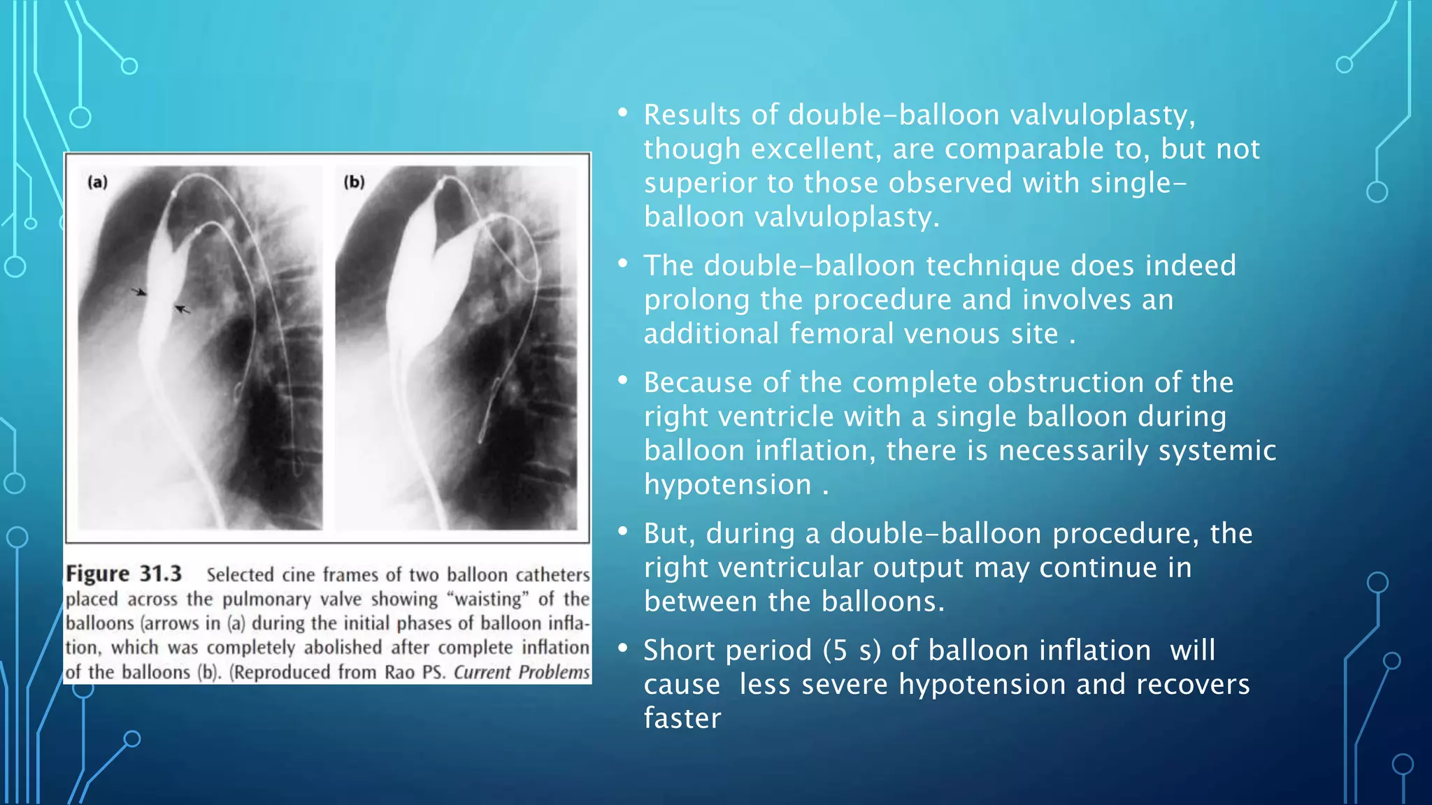 • Results of double-balloon valvuloplasty,
though excellent, are comparable to, but not
superior to those observed with single-
balloon valvuloplasty.
• The double-balloon technique does indeed
prolong the procedure and involves an
additional femoral venous site .
• Because of the complete obstruction of the
right ventricle with a single balloon during
balloon inflation, there is necessarily systemic
hypotension .
• But, during a double-balloon procedure, the
right ventricular output may continue in
between the balloons.
• Short period (5 s) of balloon inflation will
cause less severe hypotension and recovers
faster
 