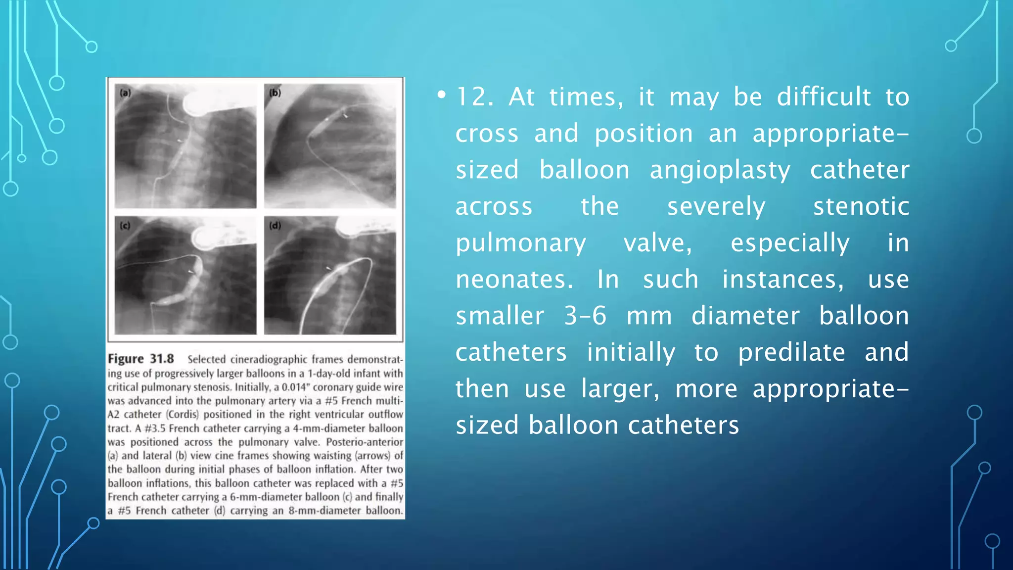 • 12. At times, it may be difficult to
cross and position an appropriate-
sized balloon angioplasty catheter
across the severely stenotic
pulmonary valve, especially in
neonates. In such instances, use
smaller 3–6 mm diameter balloon
catheters initially to predilate and
then use larger, more appropriate-
sized balloon catheters
 
