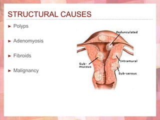 STRUCTURAL CAUSES
➤ Polyps
➤ Adenomyosis
➤ Fibroids
➤ Malignancy
 