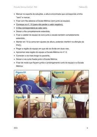 Pressão Venosa Central - PVC Tabosa AV.
2015 6
• Marcar no suporte de soluções, a altura encontrada que corresponde a linha
"zero" e marcar,
• Fixar com fita adesiva a Escala Métrica (vem junto ao equipo),
• Começar no nº. 10 (para não perder o valor negativo),
• O Dez corresponderá ao valor zero,
• Deixar a fita completamente estendida,
• Fixar o cateter do equipo do soro junto a escala também completamente
estendido,
• Manter em 10 (a cama tem ajustes de altura, podendo interferir na aferição da
PVC),
• Pegar a região do equipo em que ele se divide em duas vias,
• Aproximar esta região do equipo a Escala Métrica no nº. 0,
• Conectar a via mais longa no paciente,
• Deixar a via curta fixada junto à Escala Métrica,
• Fixar de modo que fiquem juntos o prolongamento curto do equipo e a Escala
Métrica.
Figura 01 Figura 02
Figura 03 Figura 04
 