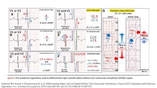 Anderson RD, Kumar S, Parameswaran R, et al. Differentiating Right- and Left-Sided Outflow Tract Ventricular Arrhythmias: Classical ECG Signatures and Prediction
Algorithms. Circ Arrhythm Electrophysiol. 2019;12(6):e007392. doi:10.1161/CIRCEP.119.007392
 