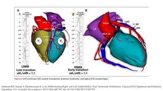 Anderson RD, Kumar S, Parameswaran R, et al. Differentiating Right- and Left-Sided Outflow Tract Ventricular Arrhythmias: Classical ECG Signatures and Prediction
Algorithms. Circ Arrhythm Electrophysiol. 2019;12(6):e007392. doi:10.1161/CIRCEP.119.007392
 