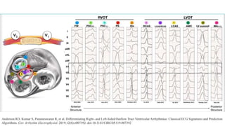Anderson RD, Kumar S, Parameswaran R, et al. Differentiating Right- and Left-Sided Outflow Tract Ventricular Arrhythmias: Classical ECG Signatures and Prediction
Algorithms. Circ Arrhythm Electrophysiol. 2019;12(6):e007392. doi:10.1161/CIRCEP.119.007392
 