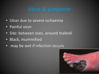 Ulcer & gangrene
• Ulcer due to severe ischaemia
• Painful ulcer
• Site: between toes, around maleoli
• Black, mummified
• may be wet if infection occurs
 