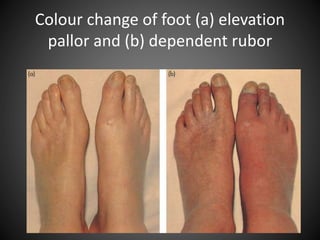 Colour change of foot (a) elevation
pallor and (b) dependent rubor
 