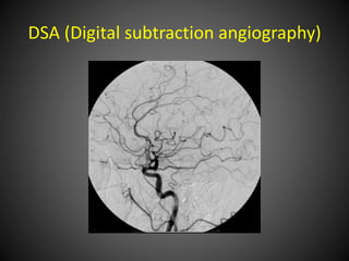 DSA (Digital subtraction angiography)
 