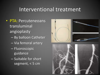 Interventional treatment
• PTA: Percuteneoans
transluminal
angioplasty
– By balloon Catheter
– Via femoral artery
– Fluoroscopic
guidance
– Suitable for short
segment, < 5 cm
 