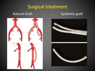 Surgical treatment
Natural Graft Synthetic graft
 
