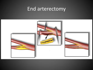 End arterectomy
 