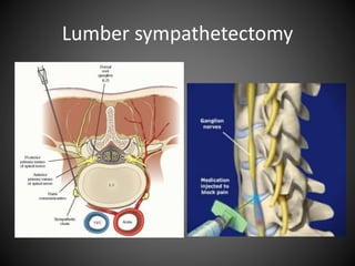 Lumber sympathetectomy
 