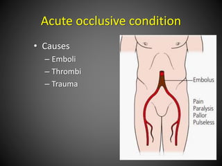 Acute occlusive condition
• Causes
– Emboli
– Thrombi
– Trauma
 