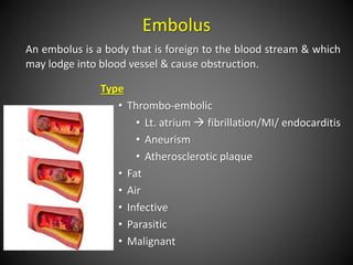 Embolus
An embolus is a body that is foreign to the blood stream & which
may lodge into blood vessel & cause obstruction.
Type
• Thrombo-embolic
• Lt. atrium  fibrillation/MI/ endocarditis
• Aneurism
• Atherosclerotic plaque
• Fat
• Air
• Infective
• Parasitic
• Malignant
 